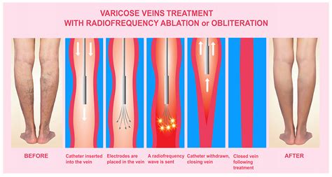 Varicose Veins and Treatment with radiofrequency ablation - Peter Brukasz MD | Addison, IL ...