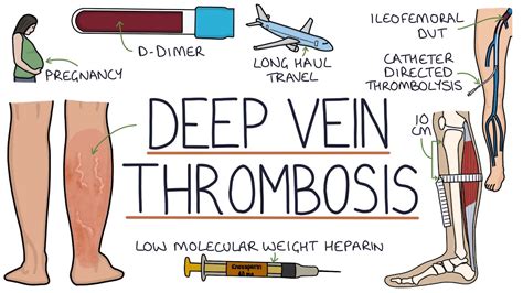 Deep Vein Thrombosis, DVT Symptoms, Causes And, 44% OFF