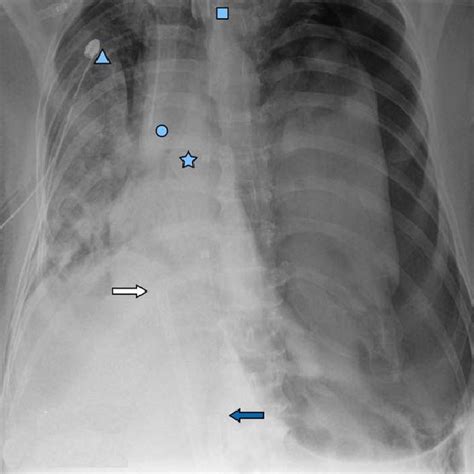 AP chest x-ray showing interval resolution of loculated pneumothorax ...