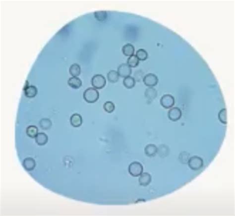 Urine Sediment Constituents Microscopy Sediment Examination Techniques Reporting The