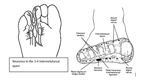 Mortons Neuroma Foot Surgery London