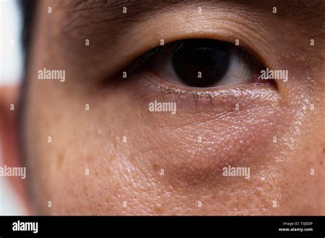 Ptosis Droopy Eyelid In Asian Male Oily Skin Type With Dark Eye Bag