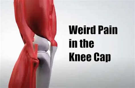 Weird Pain in the Knee Cap - IYTmed.com