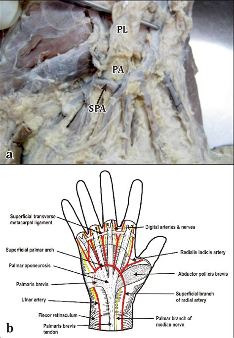 Figure 1 From Subcutaneous Superficial Palmar Arch An Unusual Variant