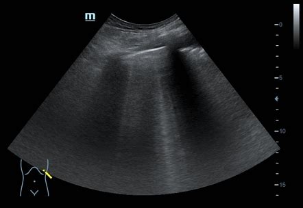 B-line (ultrasound) | Radiology Reference Article | Radiopaedia.org