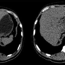 CT scan showed a large lesion arise from the caudate lobe (hepatic TB ...