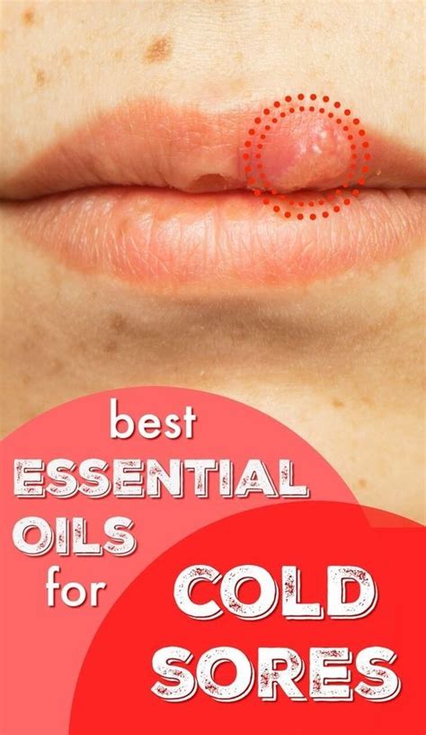 Best Essential Oils For Cold Sores Natural Remedies Cold Sore Essential Oil Essential Oils