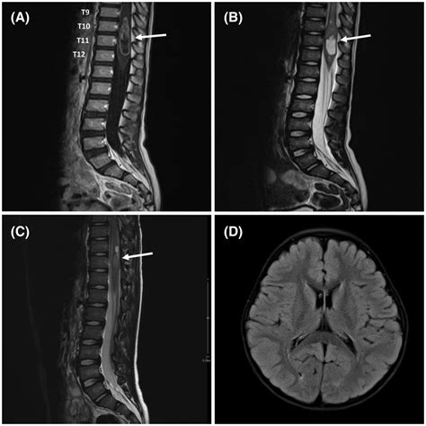 MRI Findings Of Spinal EpendymomaZFTAYAP1 Fusion A Sagittal