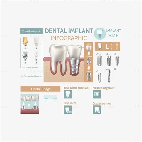 Dental Implant Infographic Vector