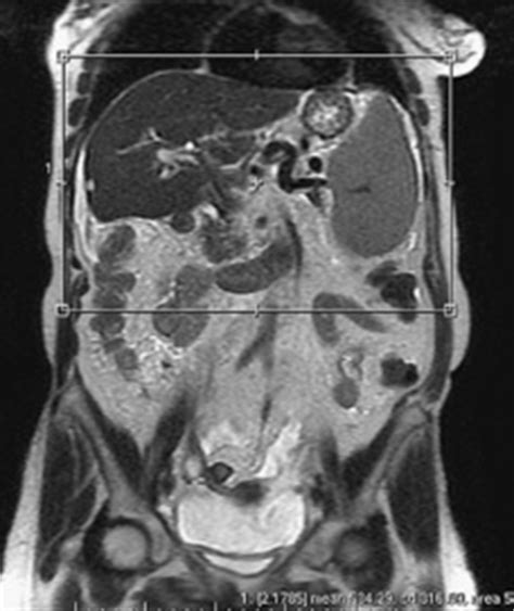 Mri Abdomen Labeled