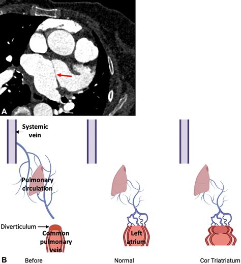 Cor Triatriatum Sinistrum Radiology