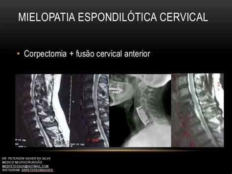 Mielopatia EspondilÓtica Cervical