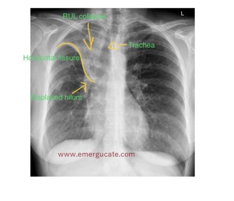 Imaging Case Of The Week 545 Answer Emergucate