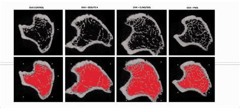 Il Trattamento Dell Osteoporosi Con Una Zeolite Modificata Mostra