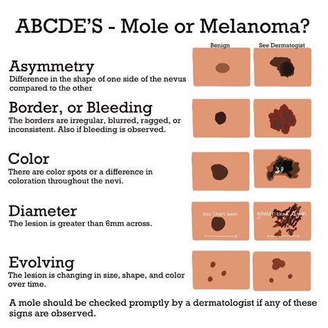 Malignant Melanoma Abcde