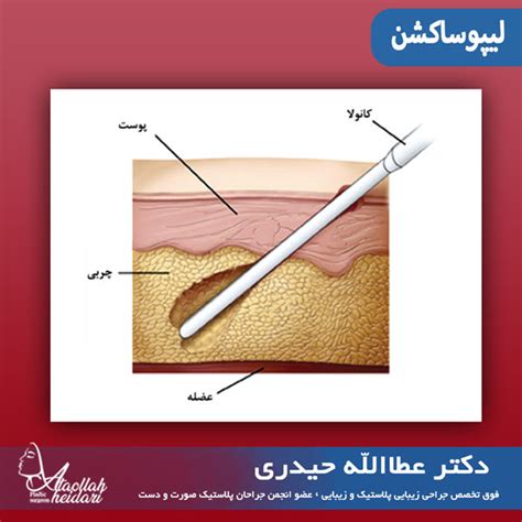 لیپوساکشن نحوه عمل لیپوساکشن عکس تخلیه چربی