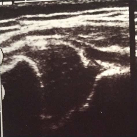 Ultrasound image of DDH Graf type IIa(-) . | Download Scientific Diagram