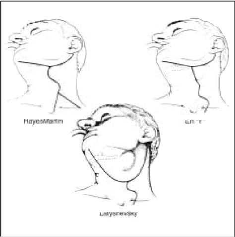 Figure From Fisioterapia Y Reeducaci N De La Degluci N En La Cirug A