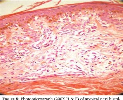 Dysplastic Nevus Histology