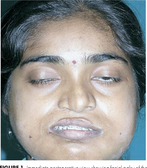 Facial Nerve Palsy