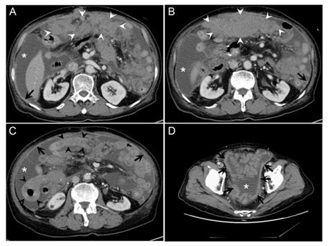 Year Old Man With A Peritoneal Lymphomatosis By Diffuse Large B Cell