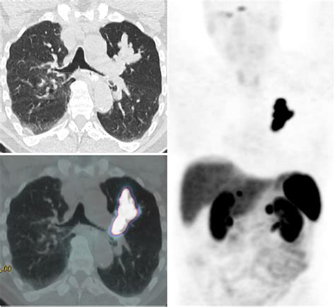 A Comparison Of 68Ga DOTATATE And 18F FDG PET CT In Pulmonary