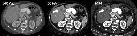 Improved Delineation Of Lesion Enhancement Pattern And Margins SsDECT