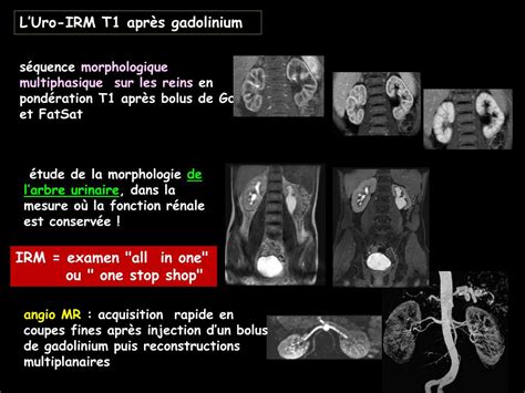 Ppt Imagerie Et Obstruction Urinaire Powerpoint Presentation Free