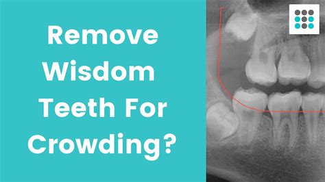 Remove Wisdom Teeth For Crowding L Dr Melissa Bailey Youtube