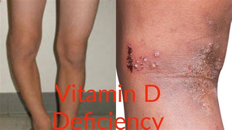 Vitamin D Deficiency Signs And Symptoms YouTube