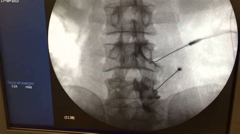 Cirugía de columna lumbar L4 L5 Las vértebras L4 L5