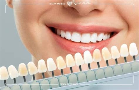 Veneers Vs Lumineers Similarities And Differences Ilajak Medical