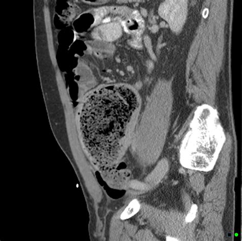 Stercoral Ulcer And Perforation Of The Sigmoid Colon Image