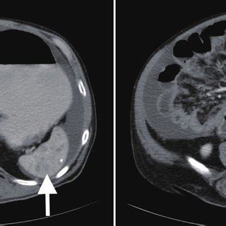 Computed Tomography Of Abdomen And Pelvis With IV Contrast Revealed A