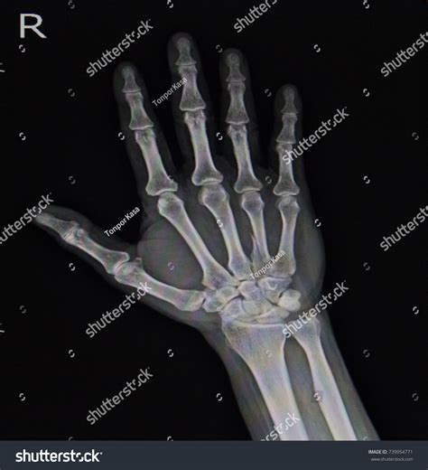 Xray Fracture Right Palm Fracture Stock Photo (Edit Now) 739954771