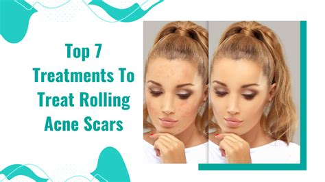 Rolling acne scar