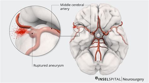 Subarachnoid Hemorrhage Vs Intracerebral Hemorrhage