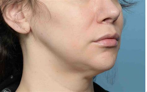 Female Custom Jawline Implant Oblique 1 Dr Barry Eppley Explore