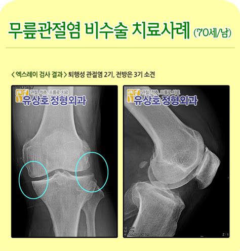 인공관절수술 없이 퇴행성관절염치료 네이버 블로그