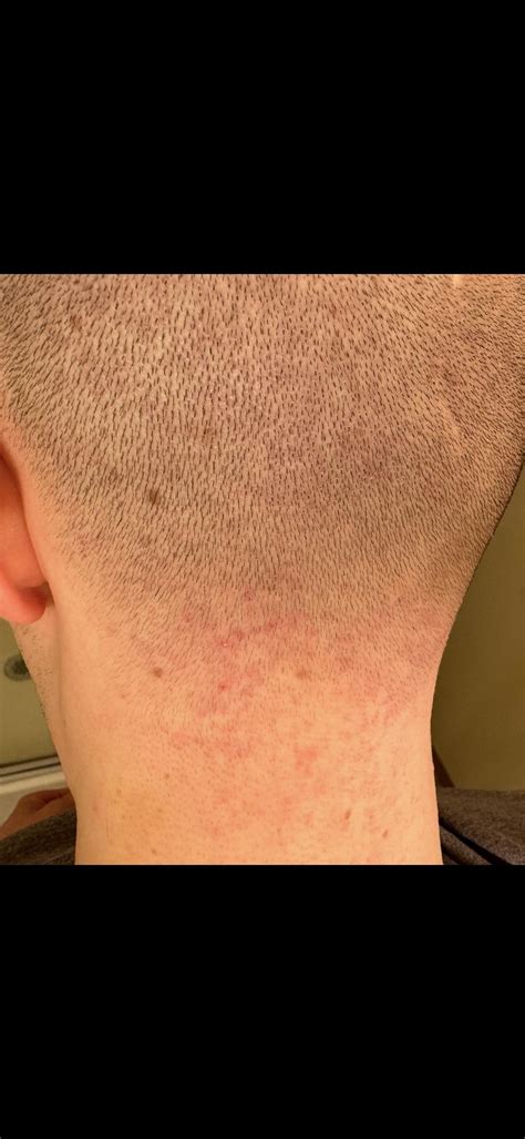 Folliculitis? : r/Folliculitis