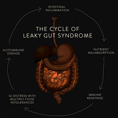 Causes Of Leaky Gut Syndrome Archives Parsons Marketing