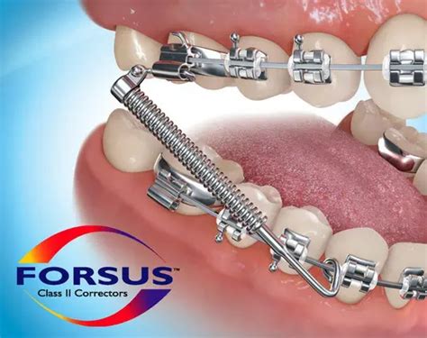 Forsus Orthodontist In Gilbert Az