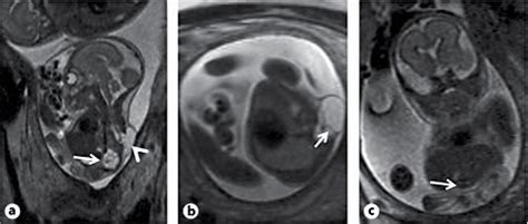 Prenatal MRI At 23 Weeks Of Gestation A Sagittal T2 HASTE Image Shows