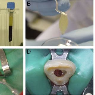 Intraoperative Photographs Of Case A Detailed View Of The