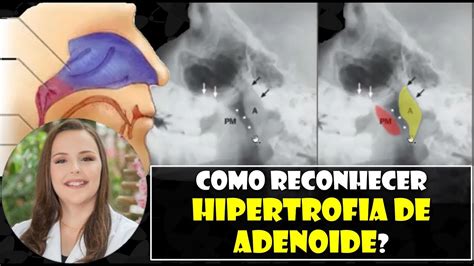 RADIOGRAFIA DO CAVUM NA AVALIAÇÃO DA HIPERTROFIA DE ADENOIDE Dra