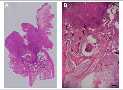 Figure 13 From Endoscopically Assisted Marginal Mandibulectomy Using An