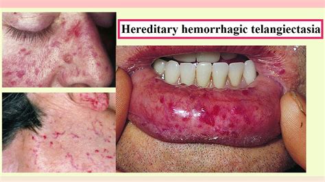 Hereditary Hemorrhagic Telangiectasia Rememberology