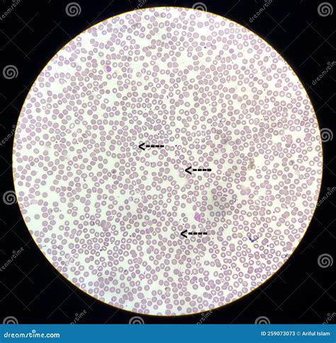 Abnormal Red Blood Cells In Blood Smear Thalassemia Patient Stock Image