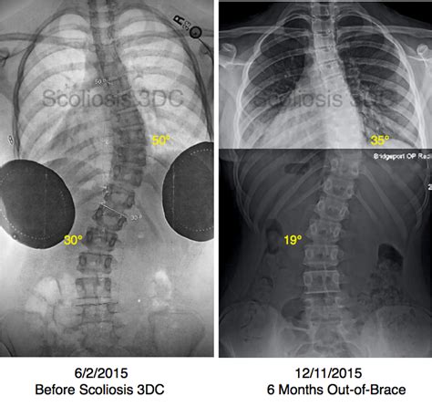 In Brace Correction Scoliosis Brace Correction 3d Scoliosis Brace