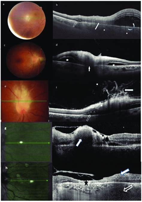 Features Of Active Lesion Color Fundus Photograph Of An Active White